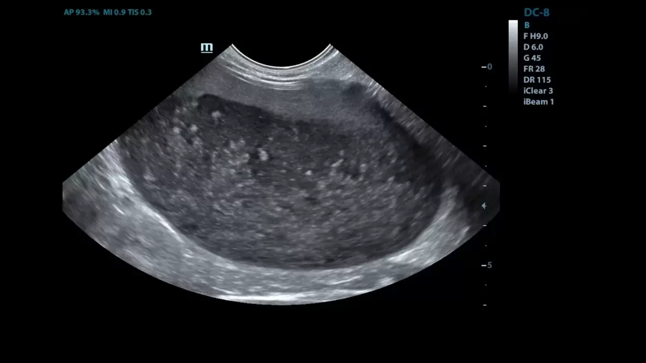 Cystitis a mengem Ultraschall Biller virum Gebrauch vun ZXCVBNQWert