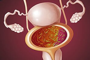 Bakteriell Cystitis an enger Fra